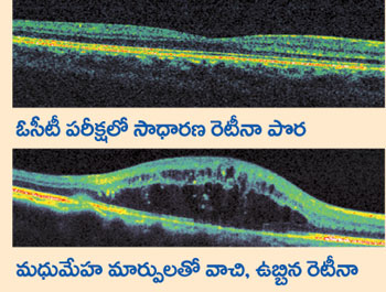retina