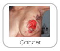 cancer
