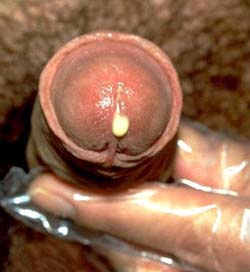 gonorrhea